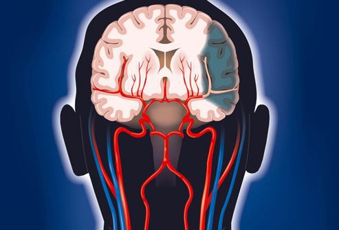 phototake_rm_photo_of_brain_damage_from_stroke